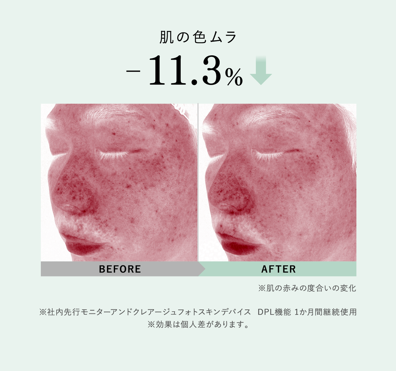 肌の色ムラ −11.3% BEFORE AFTER ※肌の赤みの度合いの変化 ※社内先行モニターアンドクレアージュフォトスキンデバイス DPL機能 1か月間継続使用 ※効果は個人差があります。
