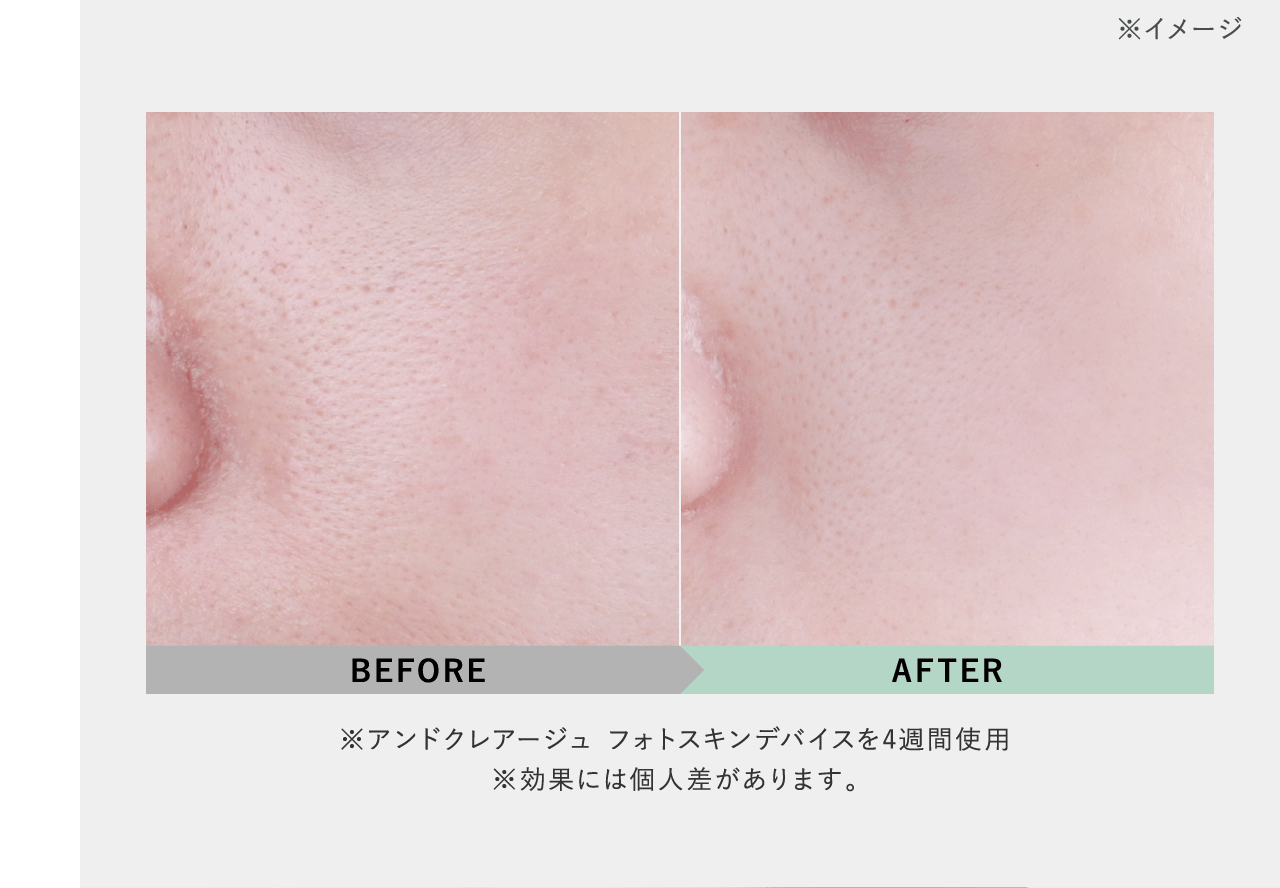 ※イメージ BEFORE AFTER ※アンドクレアージュ フォトスキンデバイスを4週間使用 ※効果には個人差があります。